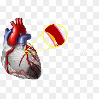 Less Pressure Is Generated By Hearts With Damaged Tissue - Coronary Artery Disease Png Clipart