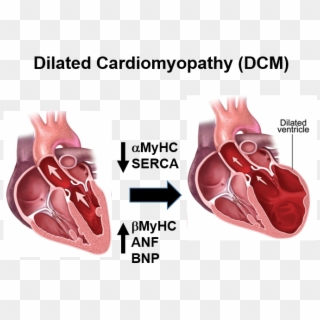 Figure 1 - Dilated Cardiomyopathy Clipart