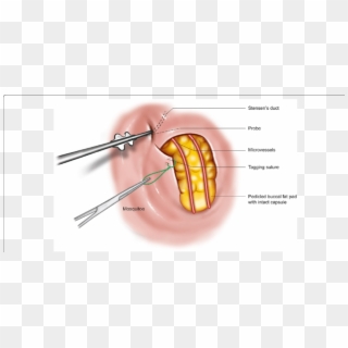 Blunt Transparent Fat - Herniation Of Buccal Fat Pad Clipart