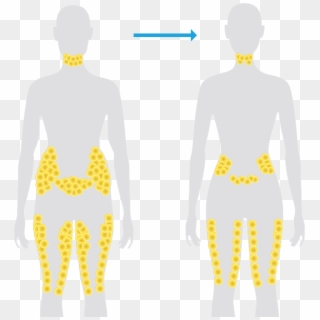 Coolsculpting® Fat Reduction - Unique Beauty And Laser Clinic Clipart