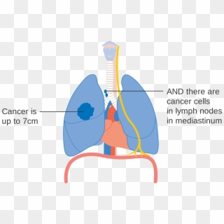 1 Of 3 Showing Stage 3a Lung Cancer Cruk - Stage 3b Lung Cancer 7 Cm Clipart