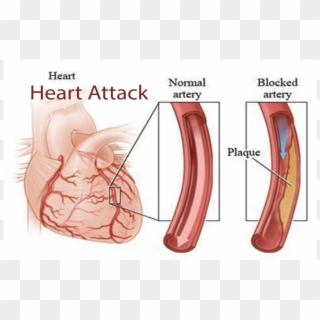 Coronary Angiography Clipart