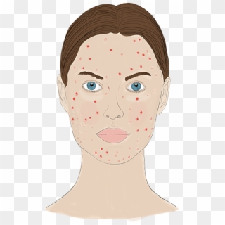 Acne Png - Illustration Clipart
