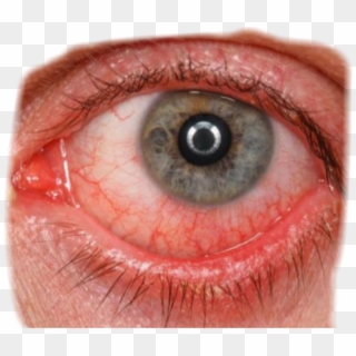 Eye Redeye Bloodshot Bloodshoteye Eyes Red - Симптом Повышенного Глазного Давления Clipart