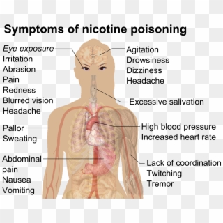 Symptoms Of Nicotine Poisoning - Nicotine Poisoning Symptoms Clipart