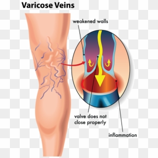By Unsightly Veins Are Delighted With The Results They - One Way Valves Veins Clipart