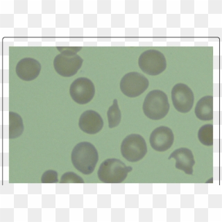 Peripheral Blood Smear With Schitocytosis - Circle Clipart