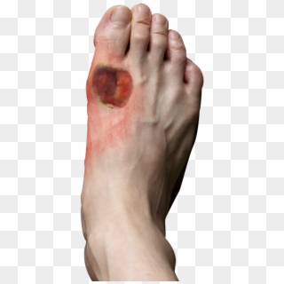 Signs And Symptoms Of Diabetic Foot - Chronic Wound Feet Clipart