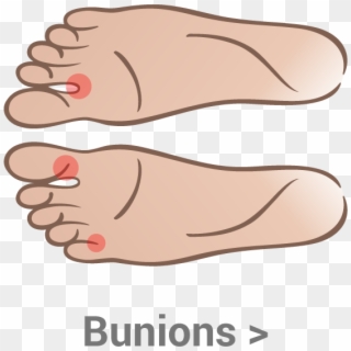 Heel-pain - Bunion On Inside Of Big Toe Clipart