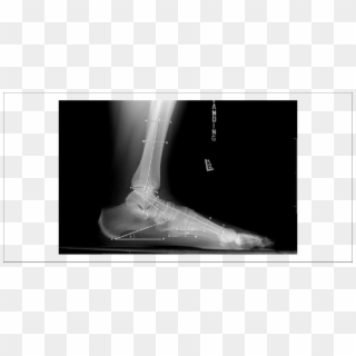 Measurements Of The Foot And Ankle On A Lateral View - Radiography Clipart